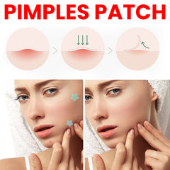Hydrocolloid Acne Pimple Patches (200 Count) Invisible Overnight Spot Treatment